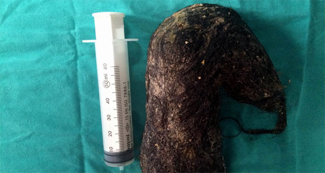 Midesinden 850 gram saç çıktı