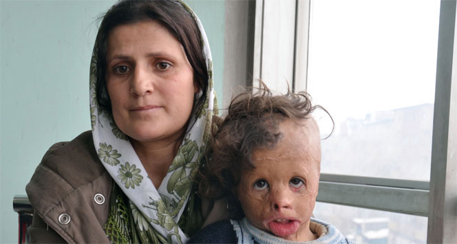 Küçük Demhat tedavi olmayı bekliyor demhat iliş,hakkari,yüz nakli