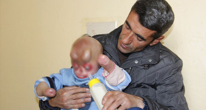 Minik Serkan'ın içler acısı hali hakkari,hakkari yüksekova,Serkan Akbaş,yüzü yanan çocuk,yüzü yanan serkan